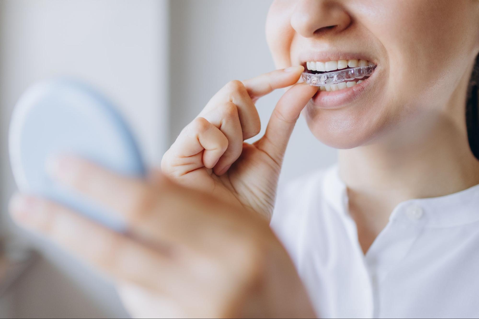 Are Clear Aligners Worth the Investment?